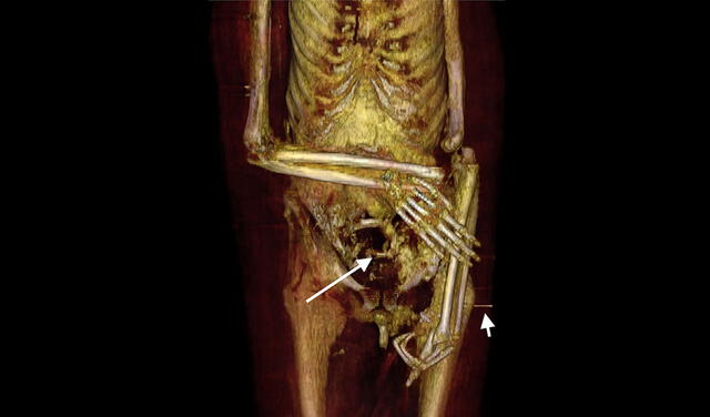 Imagen tridimensional obtenida de la parte inferior del torso y extremidades superiores. Se señalan algunos defectos probablemente ocasionados por ladrones de tumbas. Foto: Saleem et al