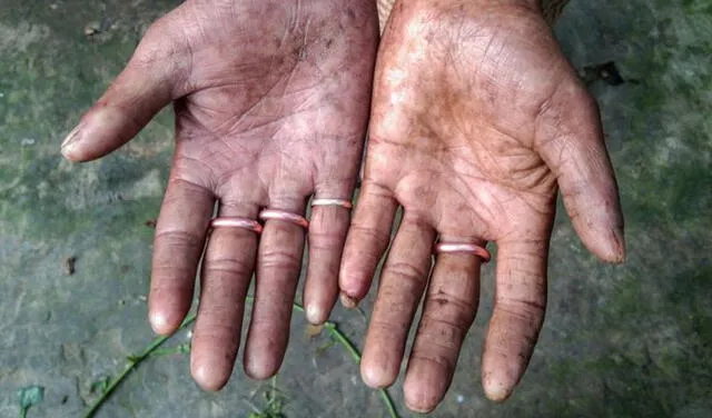 Una familia en Bangladés describe la condición que padecen y cómo la manejan. Foto: BBC