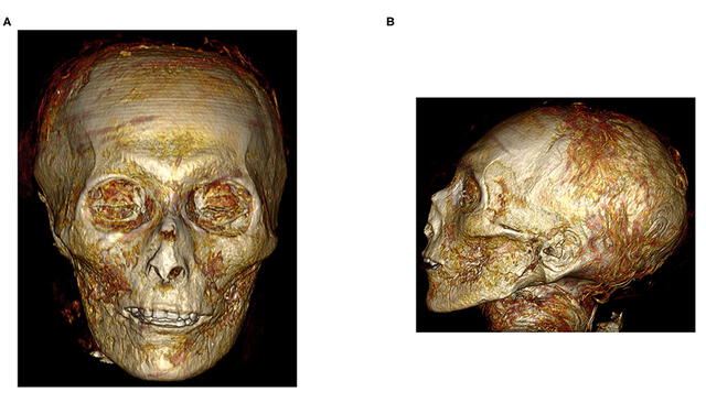 Imagen tridimensional permite ver el rostro y el resto del cráneo de la momia a través de los vendajes. Foto: Saleem et al