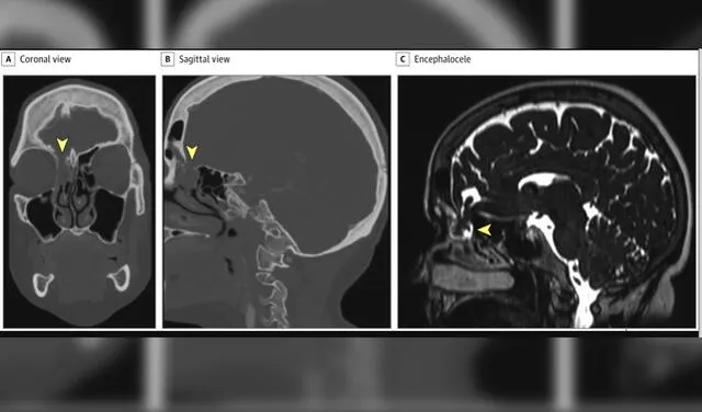 (A) Tomografía computarizada de cerebro de 2017 que muestra el encefalocele antes de la prueba para COVID-19, (B y C) resonancia magnética 2020 tras la fuga de líquido cerebral. Foto: JAMA