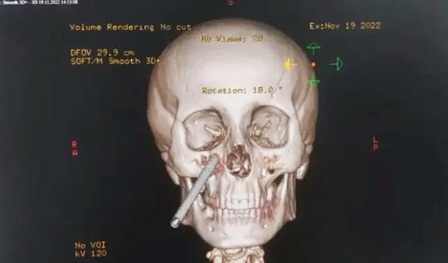 Mediante un examen de rayos X, se observa que la barra perforó su pómulo, encajándose detrás de sus ojos a solo unos centímetros de su cerebro. Foto: Ankara Masasi