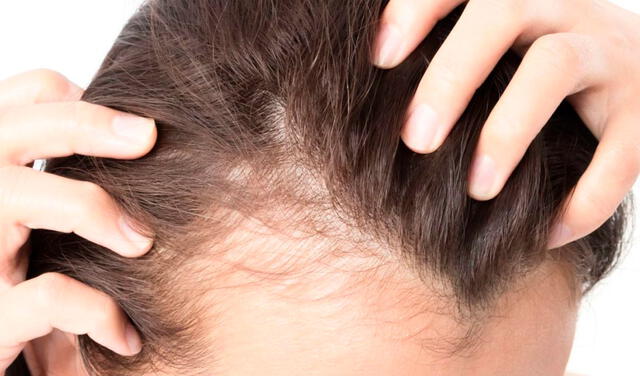 La caída de pelo en tu sueño puede simbolizar algunos de tus temores y ansiedades internas. Foto: Medical News Today