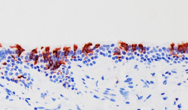 Variante ómicron del SARS-CoV-2 (en rojo) infectado con tejidos bronquiales humanos. Foto: University of Hong Kong