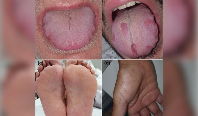 Lesiones en la lengua y manchas en manos y pies. Foto: Nuno-González et al