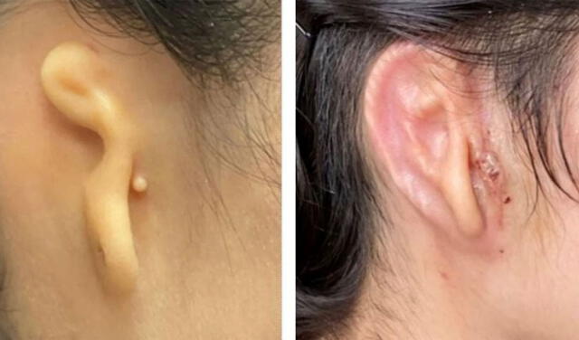 Paciente antes del trasplante (izquierda) y 30 días después de la cirugía (derecha). Fotos: Microtia-Congenital Ear Institute / 3DBio Therapeutics