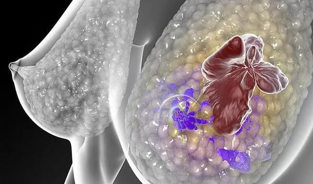 El cáncer de mama se desarrolla mejor en el tejido adiposo. Personas con sobrepeso tienen más riesgo de contraerlo | Foto: C. BICKELL/ STM