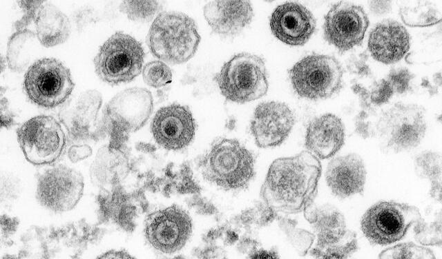 El virus Epstein-Barr (VEB) en una imagen de microscopio electrónico. Foto: German Cancer Research Center (DKFZ)