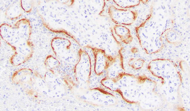 Células placentarias infectadas (rojo) en un mortinato. Foto: Colegio de Patólogos Estadounidenses, Archivos de Patología y Medicina de Laboratorio