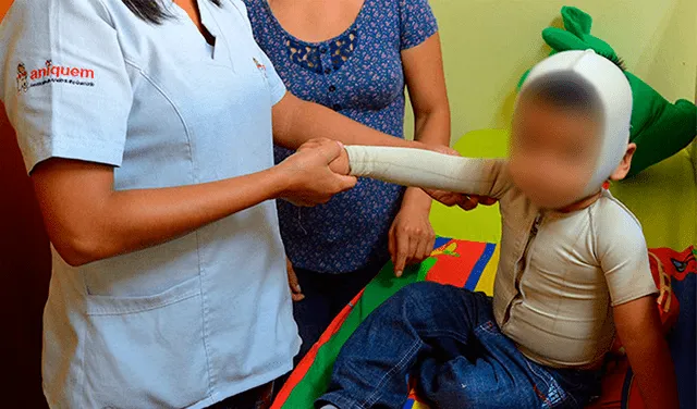 Aniquem: tratamiento de quemaduras en niños bordea los S/ 5.000