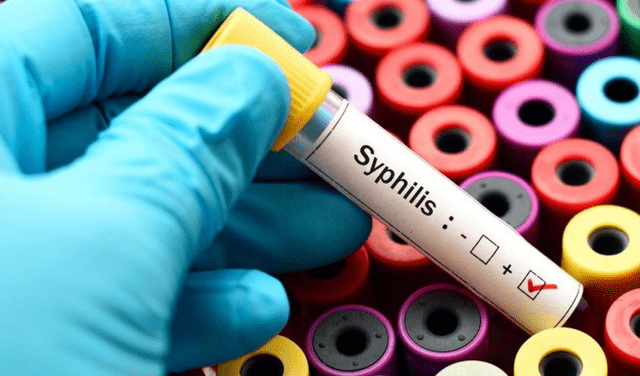 ¿Cuáles son los síntomas del sífilis?
