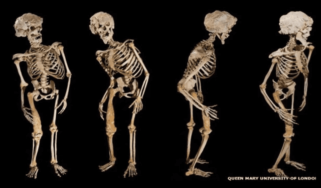 Los huesos de Joseph Merrick están en el Hospital de Londres.