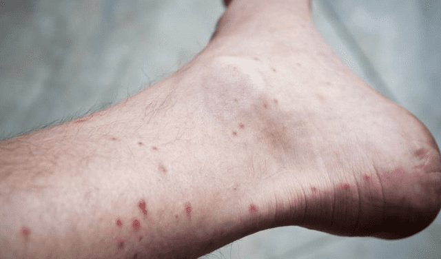Los mosquitos acostumbra picar el tobillo de las personas por el olor que esta parte del cuerpo emana
