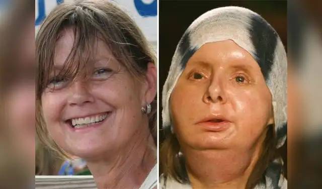 Charla Nash antes y después de su trasplante facial. Foto: NBC