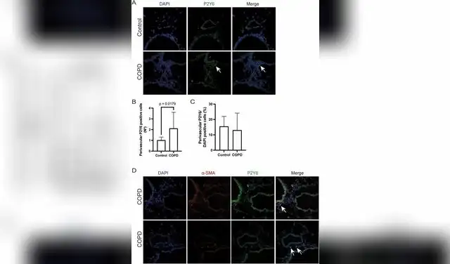 Células perivasculares positivas para P2Y6 y evaluación de la coexpresión de α-SMA/P2Y6 en el modelo de EPOC. Foto: Science Direct