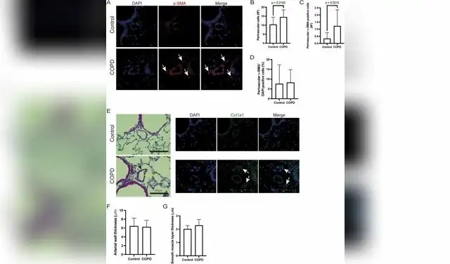 Células perivasculares α-SMA positivas y grosor de la pared arterial en el modelo de EPOC. Foto: Science Direct
