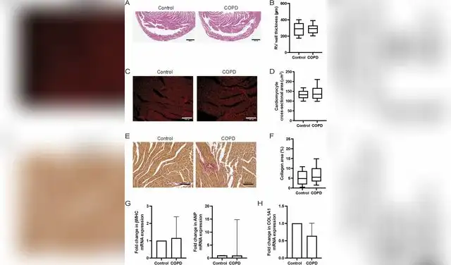 Determinación de marcadores histológicos y moleculares de hipertrofia y fibrosis del ventrículo derecho en el modelo de EPOC. Foto: Science Direct