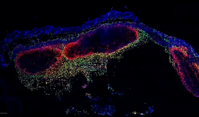 Microscopía de una sección transversal de piel de ratón con tumores de melanoma. Los macrófagos se muestran en verde y amarillo e intentan contener localmente el cáncer. Foto: Laboratorio Phan / Instituto Garvan Microscopía de una sección transversal de piel de ratón con tumores de melanoma. Los macrófagos se muestran en verde y amarillo e intentan contener localmente el cáncer. Foto: Laboratorio Phan / Instituto Garvan