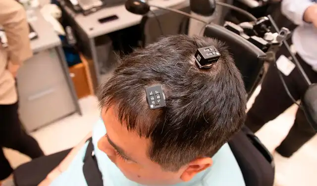 Se implantaron cinco conjuntos de electrodos en el cerebro de Thomas. Foto: Institutos Feinstein para la Investigación Médica Se implantaron cinco conjuntos de electrodos en el cerebro de Thomas. Foto: Institutos Feinstein para la Investigación Médica