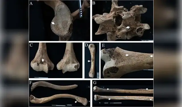 Lesiones y cambios de Ita: glenoide (A), vértebras (B), húmero (C), músculo meñique (D), fémur (E) y ligamentos (F,G). Foto: Frontiers in Environmental Archaeology Lesiones y cambios de Ita: glenoide (A), vértebras (B), húmero (C), músculo meñique (D), fémur (E) y ligamentos (F,G). Foto: Frontiers in Environmental Archaeology