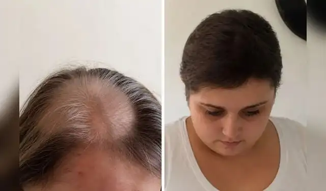 Las secuelas de las quimioterapias que Becky recibió durante años. bdbd