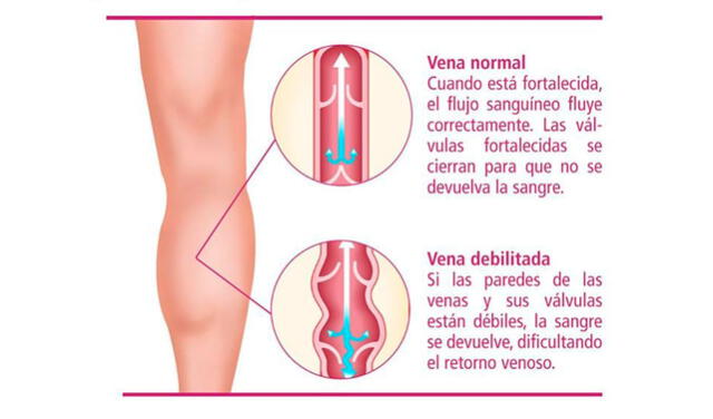 Venas de las piernas Venas de las piernas