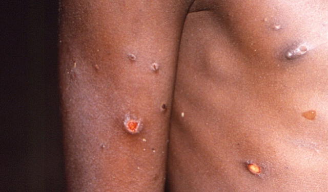 En África, la mayoría de pacientes con la nueva variante de mpox son menores de 15 años. Foto: difusión   