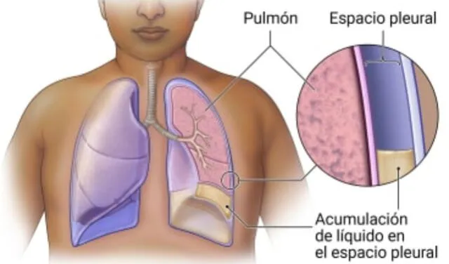  Espacio pleural: Foto: Kaiser Permanente.<br><br>    