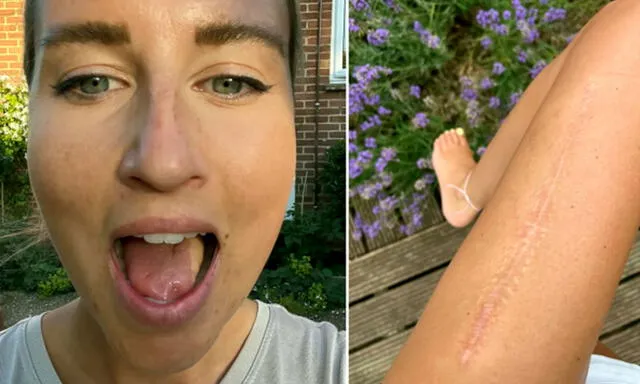 Le extirpan un pedazo de lengua y se la reconstruyen con parte de su muslo: “tengo en la boca pecas de mi pierna”