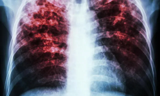 México duplica sus casos de tuberculosis y presenta escasez de la vacuna BCG