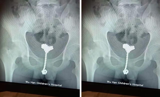 Tiene 12 años, se introdujo 31 bolas magnéticas en el pene y terminó en el  hospital