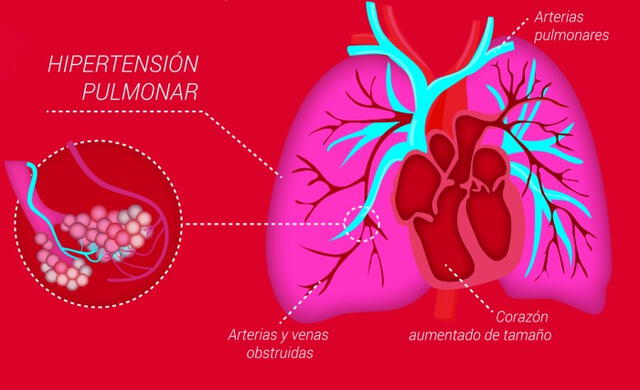  La hipertensión pulmonar puede causar el aumento del tamaño del corazón. Foto: Fundación contra la HP   