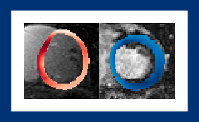 El algoritmo utiliza imágenes de resonancia magnética sin procesar. Detectó alto riesgo en el corazón dentro del círculo rojo. Foto: Universidad de Hopkins