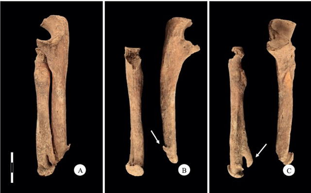 Fractura curada del antebrazo derecho. (A) Vista completa. (B) Espolones óseos en el cúbito. (C) Espolones óseos en el radio. Foto: Micarelli et al.