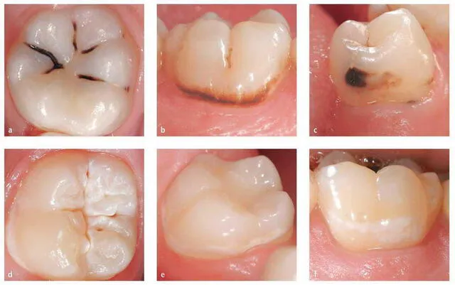 Distintos ejemplos de lesiones de caries. Foto: Elsevier / Quintessence