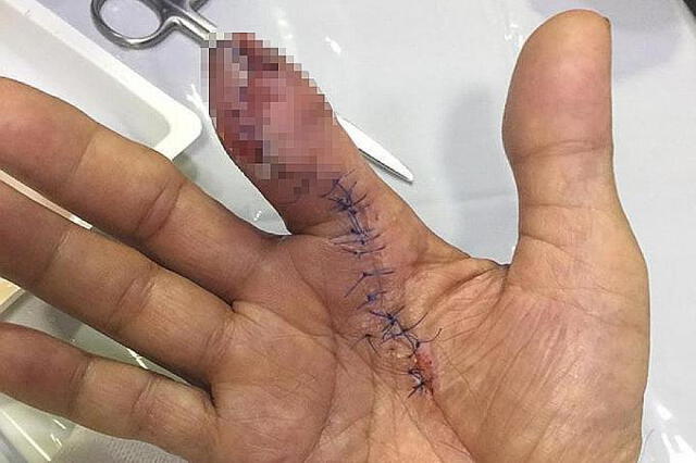 Hombre pierde medio dedo tras infectarse con una bacteria 'comecarne' al lavar unas gambas