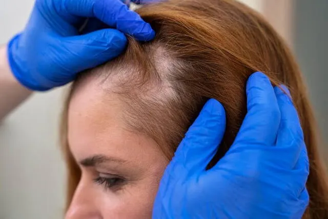  La alopecia es una enfermedad que afecta tanto a hombres como mujeres. Foto: difusión   