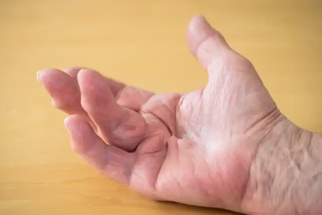 La enfermedad de Dupuytren ocurre cuando uno o más dedos se contraen hacia la palma de la mano. Foto: Infosalus La enfermedad de Dupuytren ocurre cuando uno o más dedos se contraen hacia la palma de la mano. Foto: Infosalus