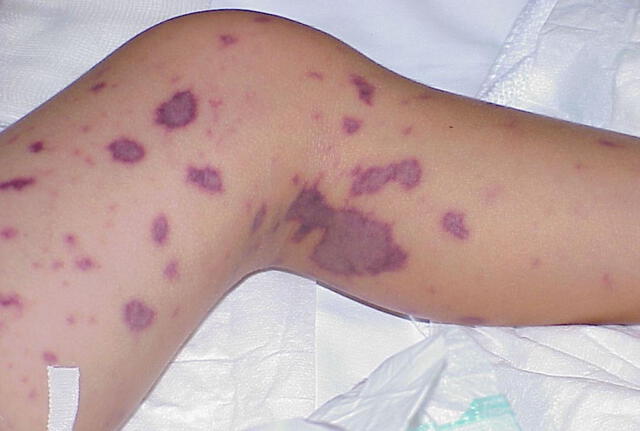 La meningitis puede ocasionar una septicemia grave. Foto: Andina   