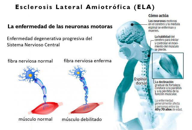 La ELA una enfermedad neurodegenerativa progresiva, a medida que avanza el deterioro se incrementa la pérdida de la movilidad en las extremidades. Foto. ELAPerú.