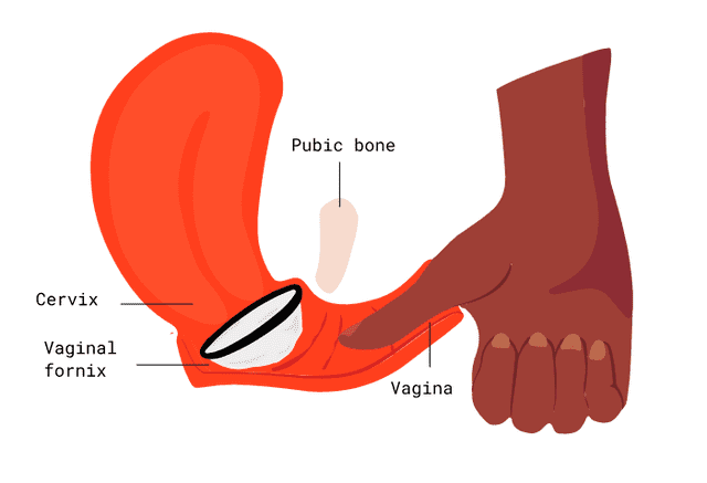  El disco menstrual se dobla para ser insertado y se asienta bajo el cuello uterino. Foto: Flexfits   