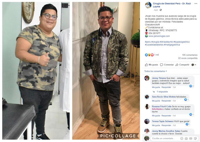 CHACALONCITO JR BAJA DE PESO CIRUGIA