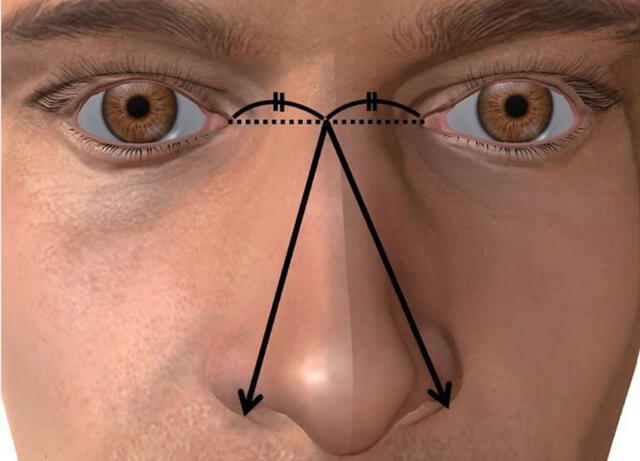 El tamaño de la nariz se definió como la mayor distancia entre el punto medio de los ángulos oculares y el exterior del ala nasal izquierda o derecha. Imagen: Ikegaya et al