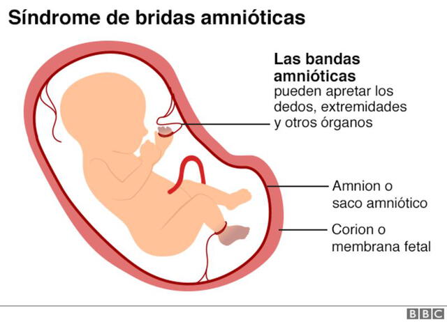 El síndrome de bridas amnióticas provoca lesiones y mutilaciones en el feto. Fuente: BBC