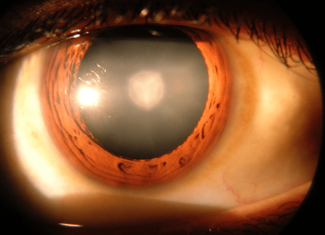 Cataratas en el ojo humano. Foto: Wikipedia