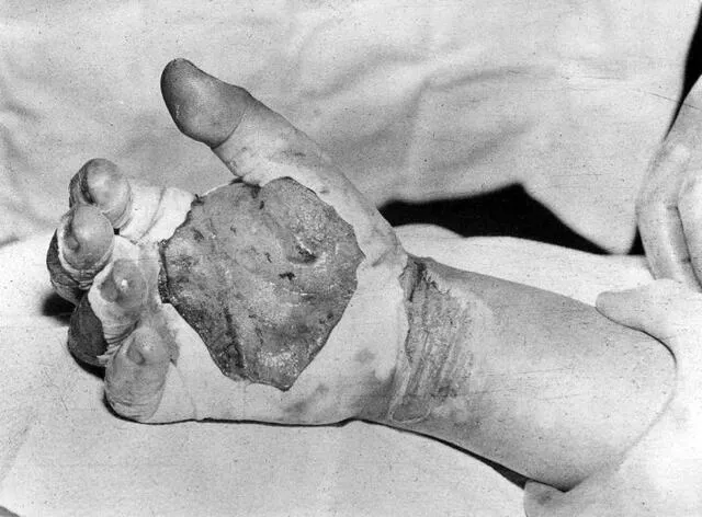 La mano quemada y llena de ampollas de Harry Daghlian. Foto: Los Alamos National Laboratory