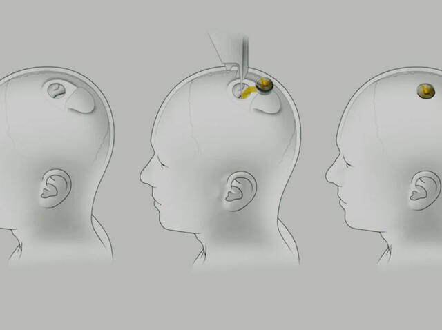 En la empresa de Musk han probado con éxito en cerdos un chip que implantado en el cráneo permite medir la actividad cerebral. Foto: Heraldo   