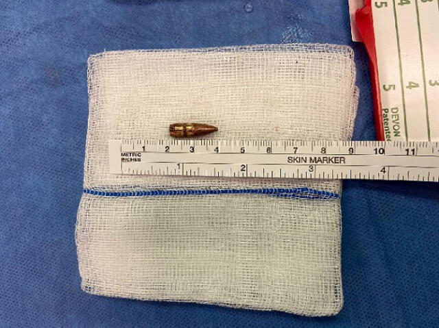 La baja que fue extraída del cerebro del chico. Foto: Hospital Universitario de Hadassah (The Times of Israel)