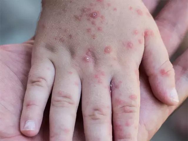 Cuatro regiones en alerta epidemiológica por brotes del virus coxsackie. FOTO: Instagram / Vital Health