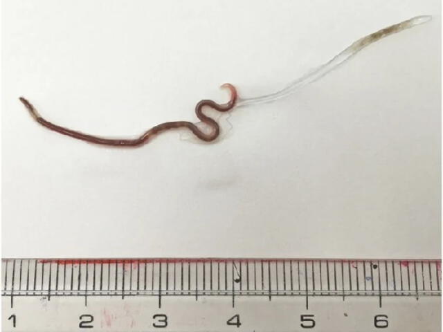 Este gusano era una larva de cuarta etapa de Pseudoterranova azarasi. Foto: Science Alert