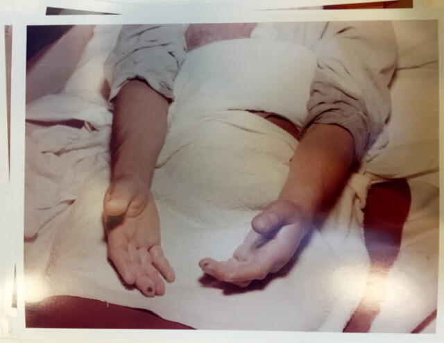 Las manos de Louis Stolin después de su ingreso en el hospital. Foto: Los Alamos National Laboratory / Biblioteca pública de Nueva York / Nuclear Secrecy